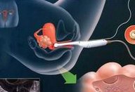 四川大学华西第二医院做三代试管成功率如何？一文读懂需要花多少钱