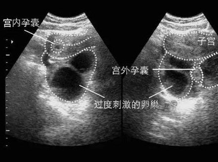 选择三代试管婴儿的费用支出情况，潜在经济负担的真实分析