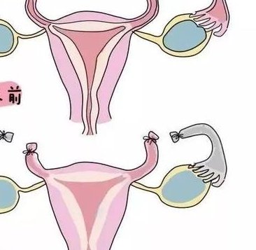 因输卵管问题引起的不孕症，做试管婴儿可行吗？